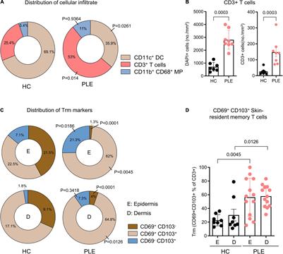 Accumulation of Cytotoxic Skin Resident Memory T Cells and Increased Expression of IL-15 in Lesional Skin of Polymorphic Light Eruption